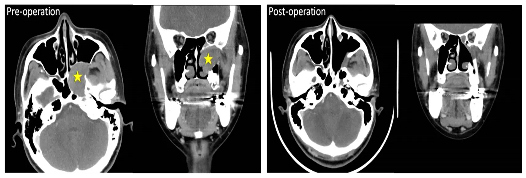 19.Sinonasal tumor skull base surgery1