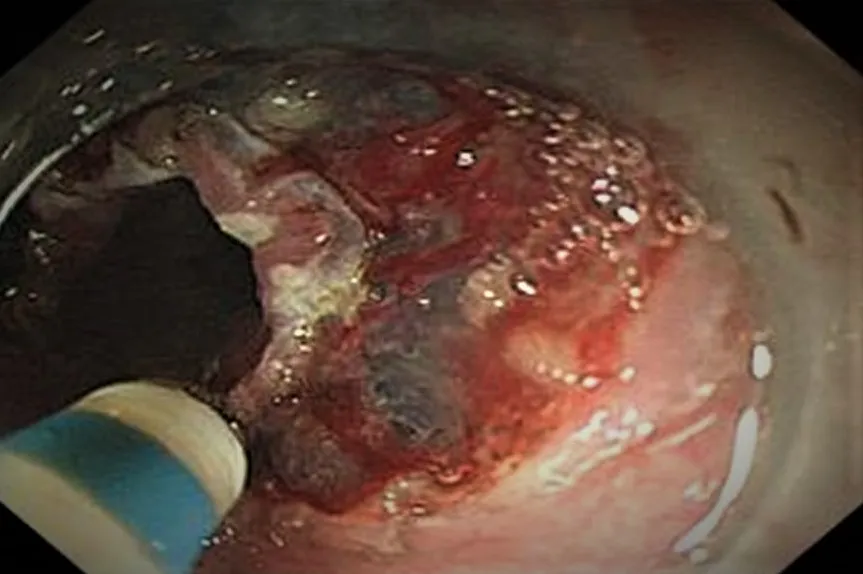 23.Interventional endoscopy1