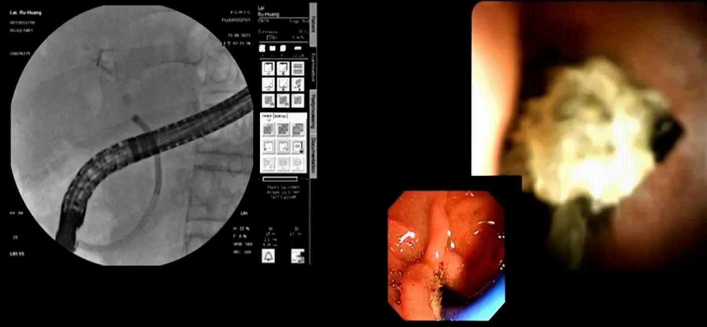 23.Interventional endoscopy2