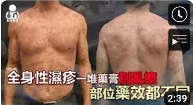 擦類固醇藥膏出現血絲，快停藥找醫師！