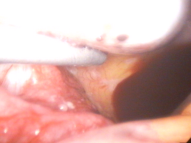 腹腔鏡檢查4.bmp