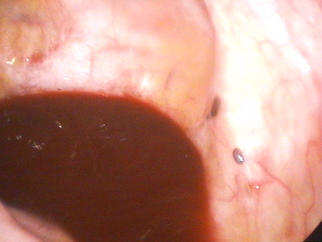 腹腔鏡檢查2.bmp