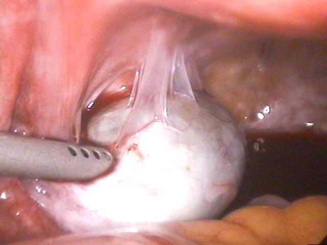 腹腔鏡檢查3.bmp