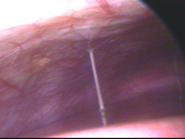 骨盆腔沾粘2.jpg