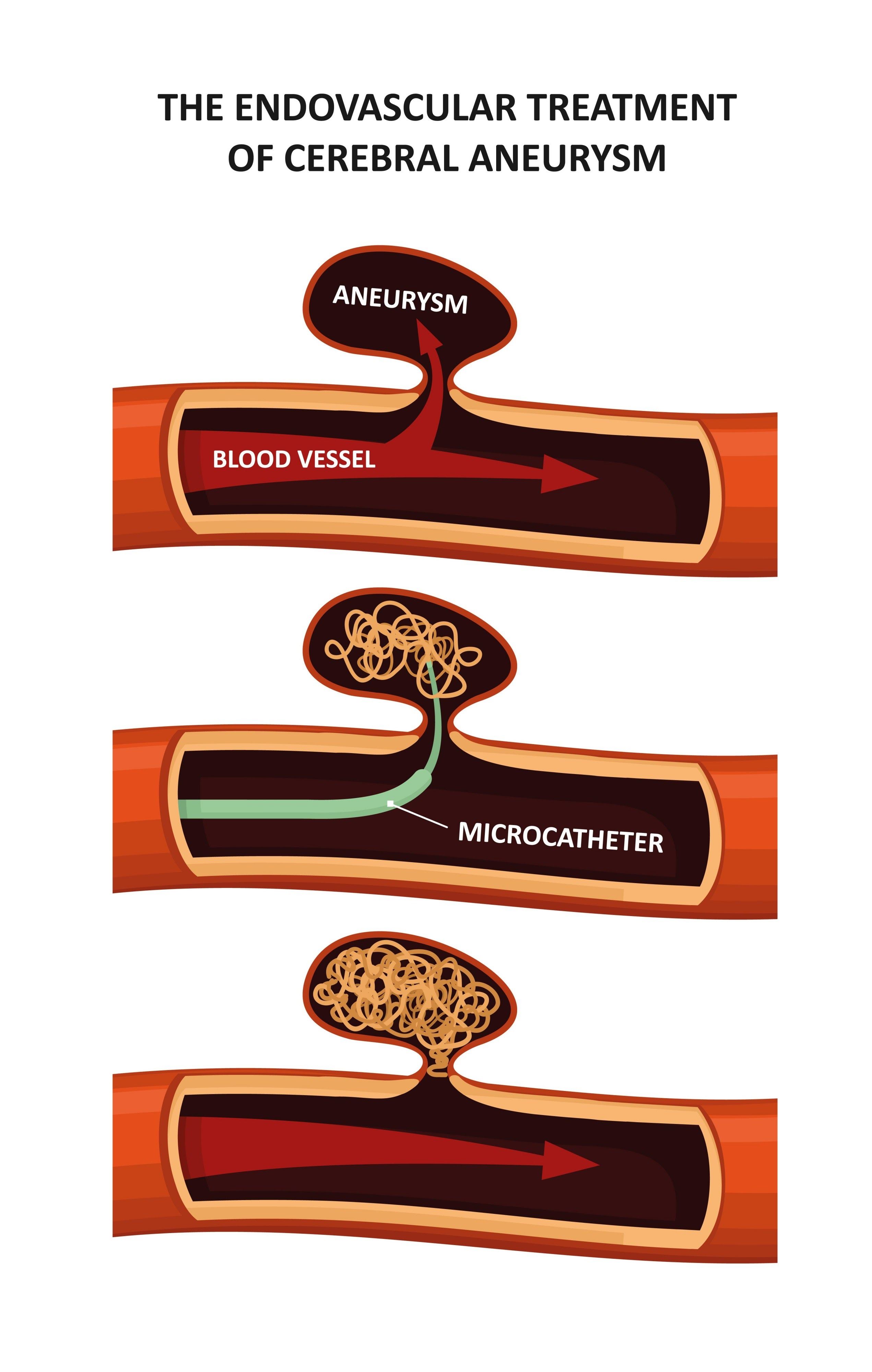Embolization