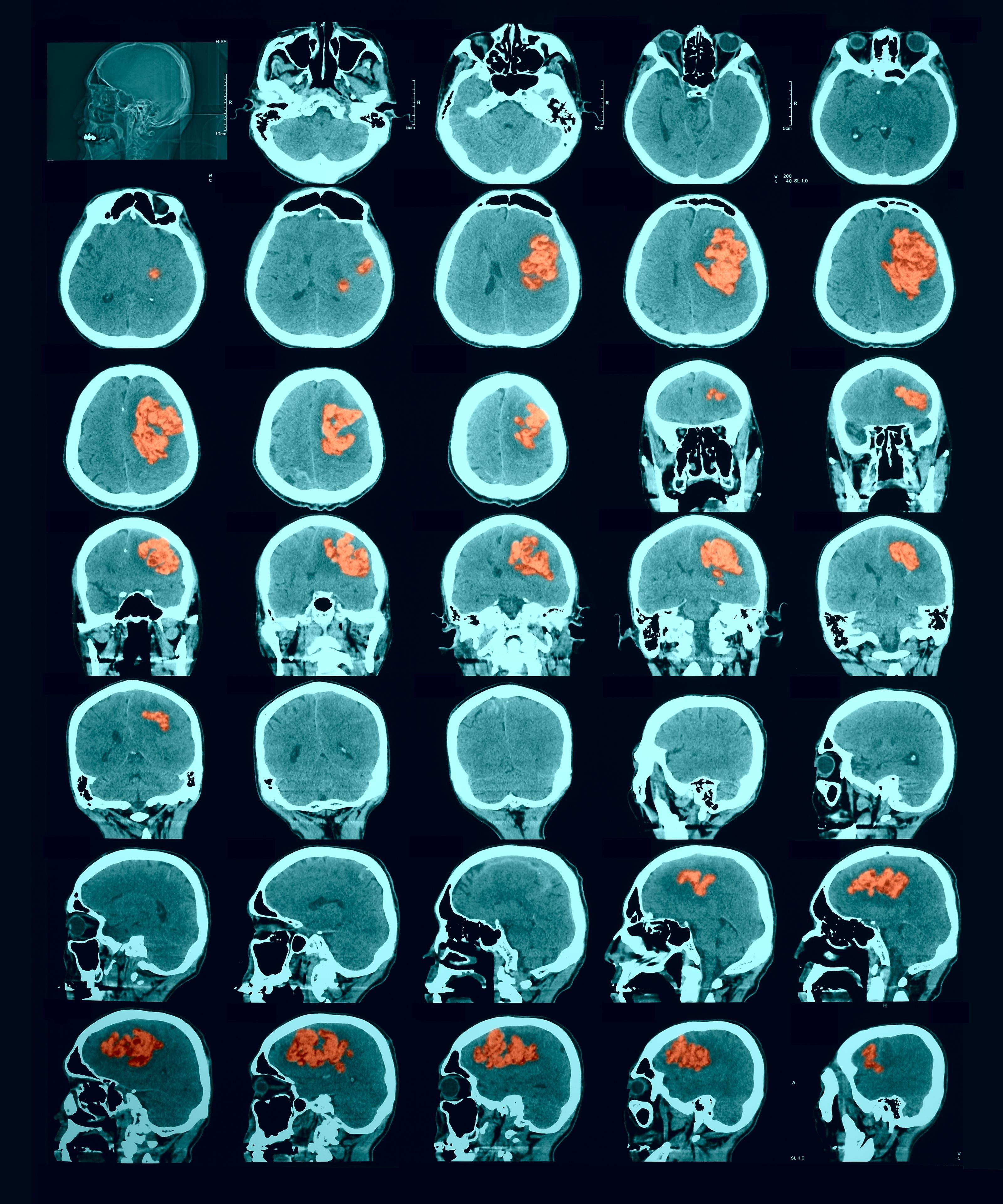 brain ct